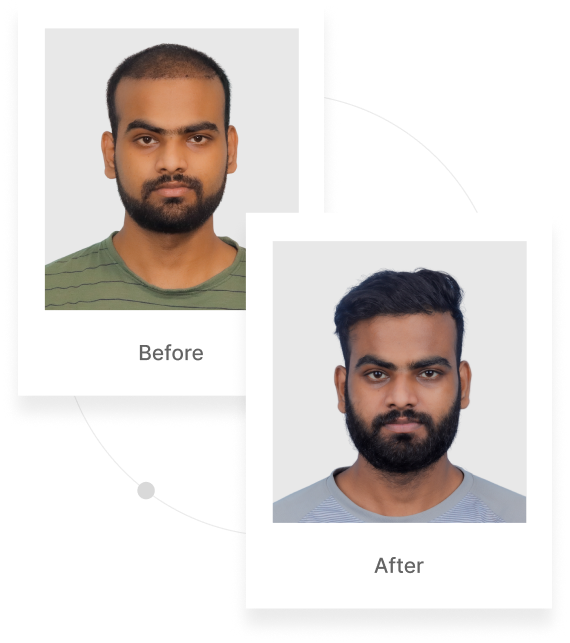 Best FUE Hair Transplant in India - QHT Clinic - Hair Transplant ...