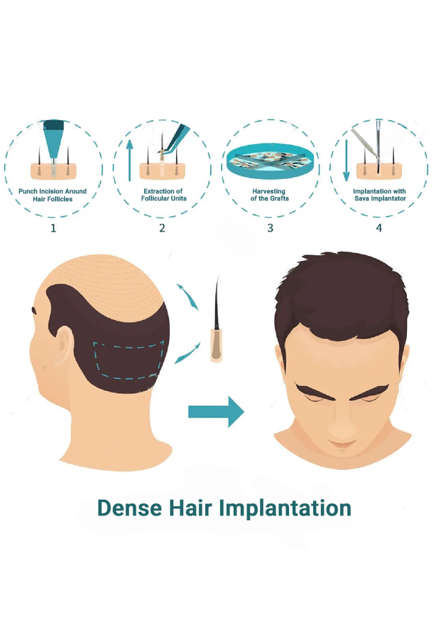 fue-vs-dense-hair-implantation-hair-transplant-procedures-qht-clinic