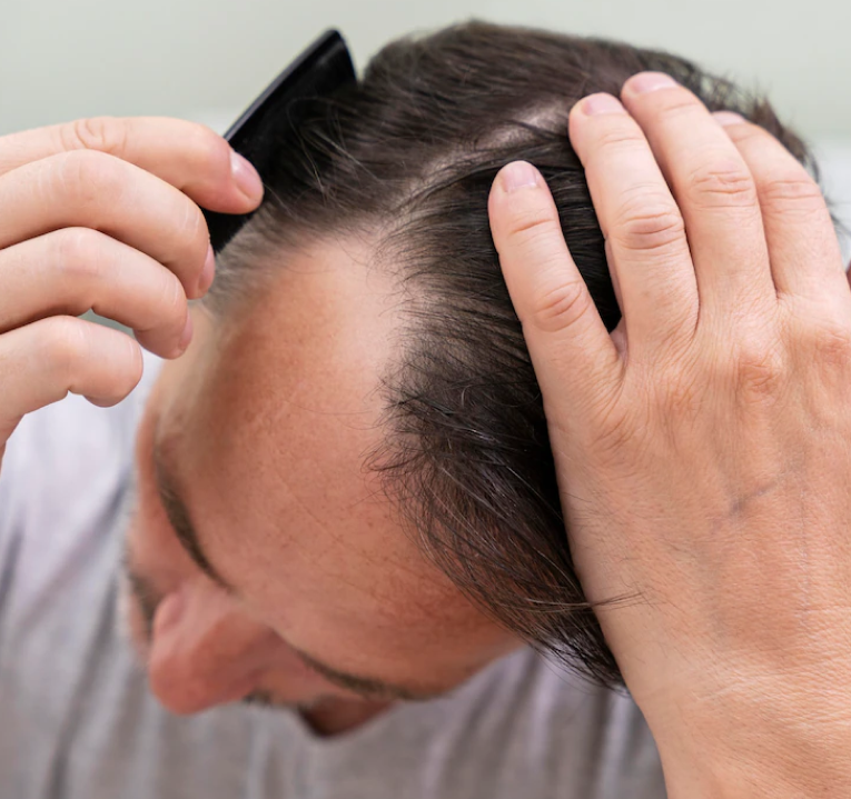 Hair FallLoss  Reasons Procedure Cost Risks Recovery