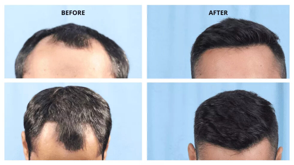 Hair Loss Treated By Transplanting 1,806 Hair Grafts With FUE/DHI Hair ...