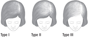 PATTERNS OF FEMALE HAIR LOSS