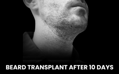 Beard Transplant After 10 Days