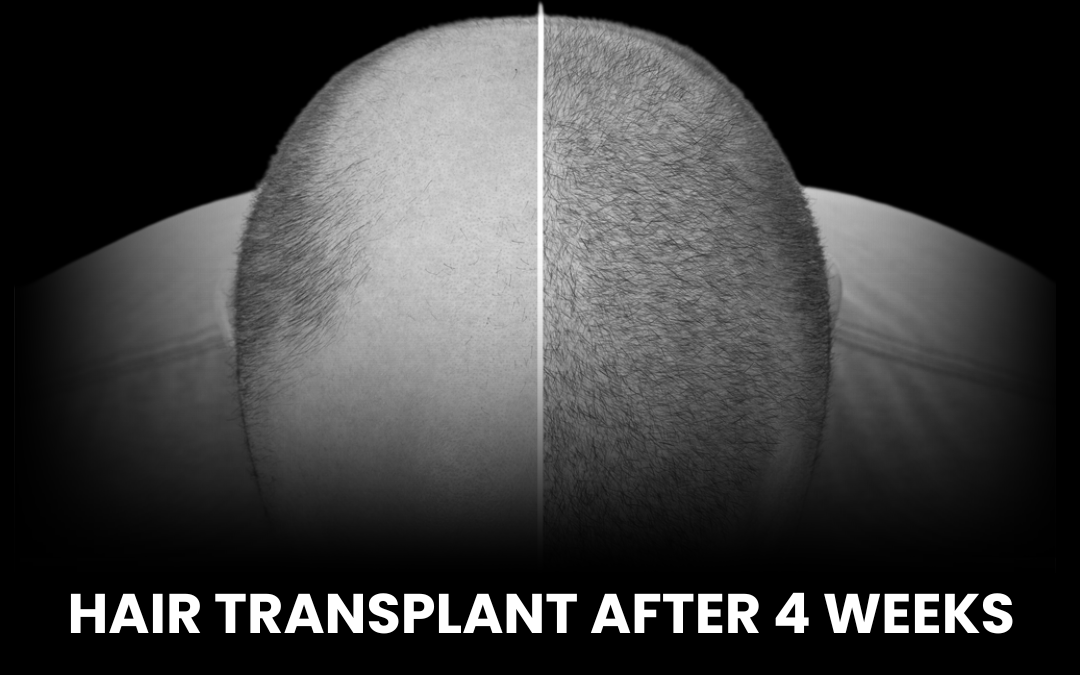 Before and after comparison of the scalp showing hair growth progress at 4 weeks post hair transplant surgery.
