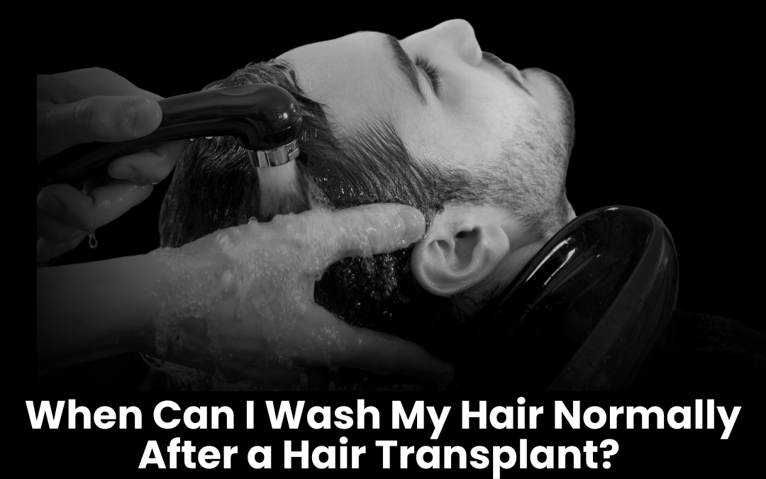 When Can I Wash My Hair Normally After a Hair Transplant?