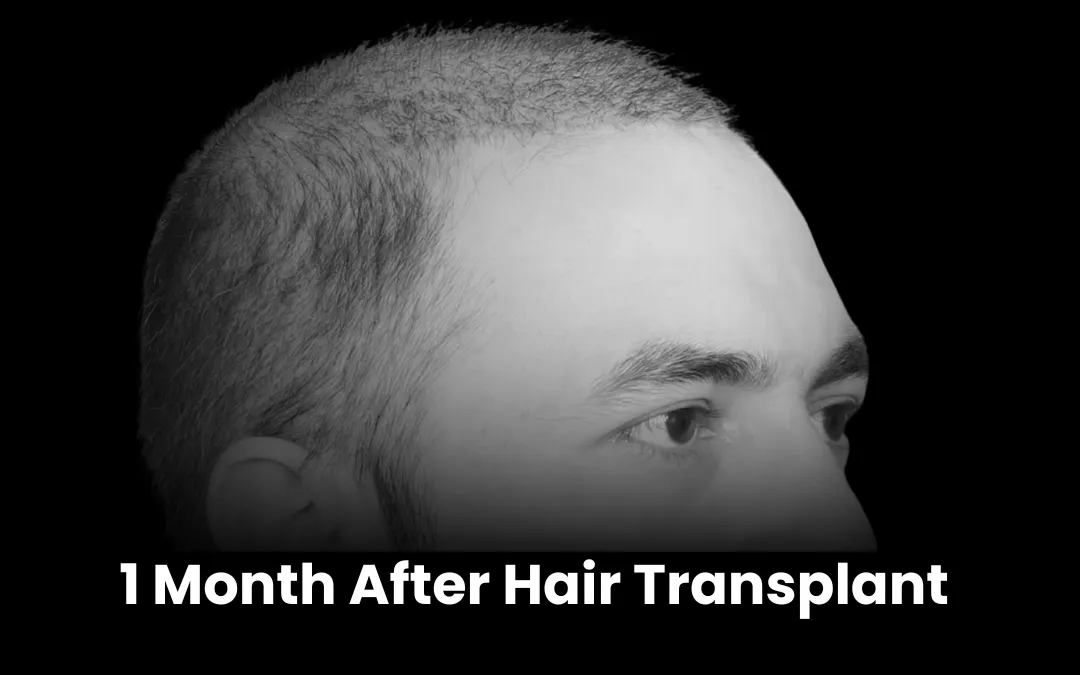 1 Month After Hair Transplant