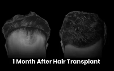 1 year after hair transplant