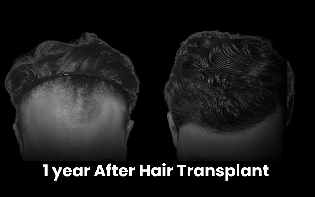 1 year after hair transplant