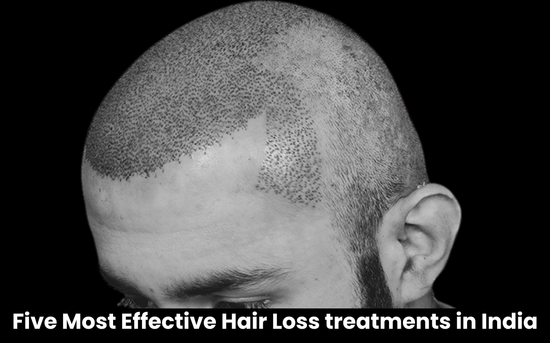 Five Most Effective Hair Loss treatments in India