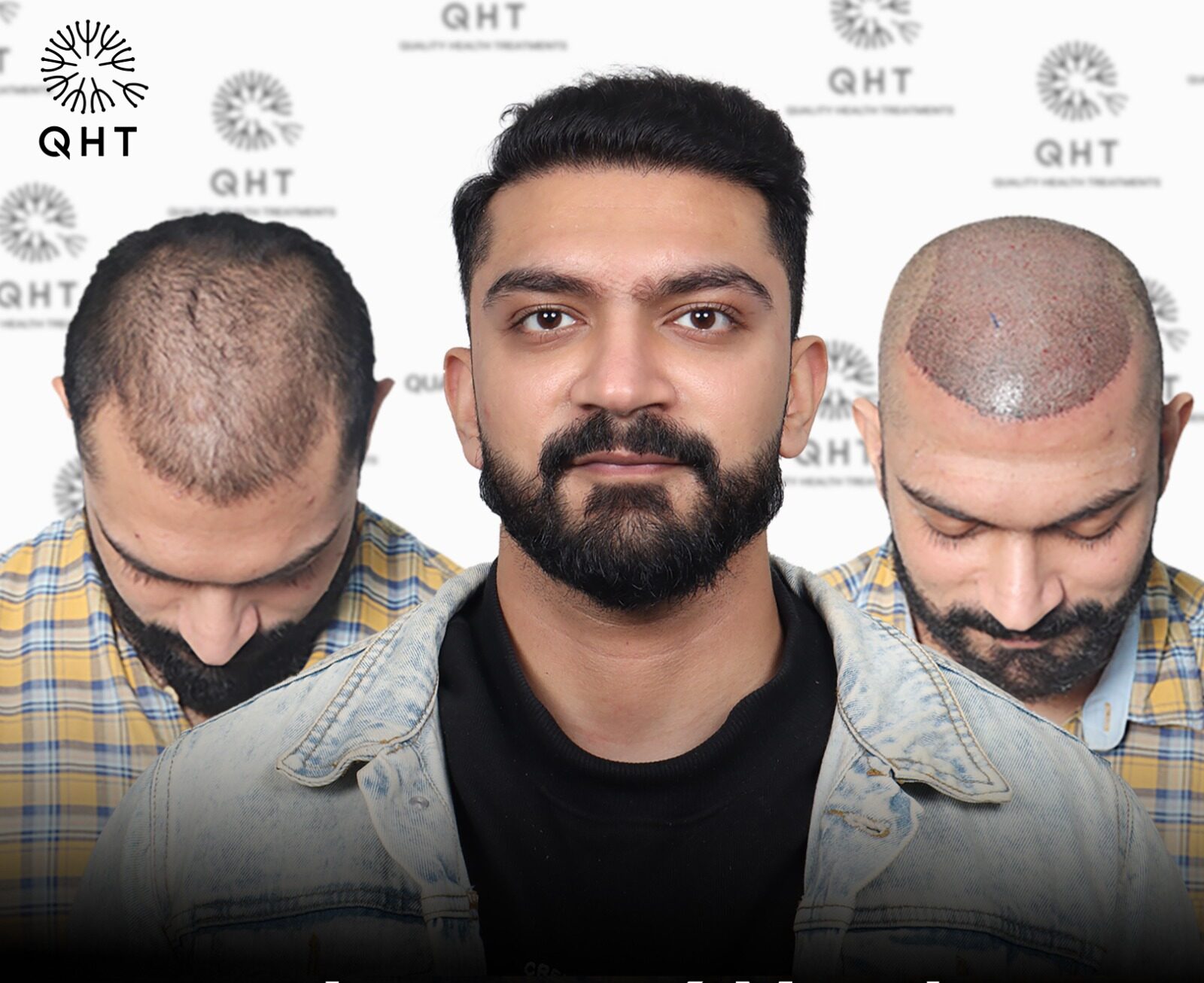 Dense Hair Transplant in India Dense Hair Transplant in India