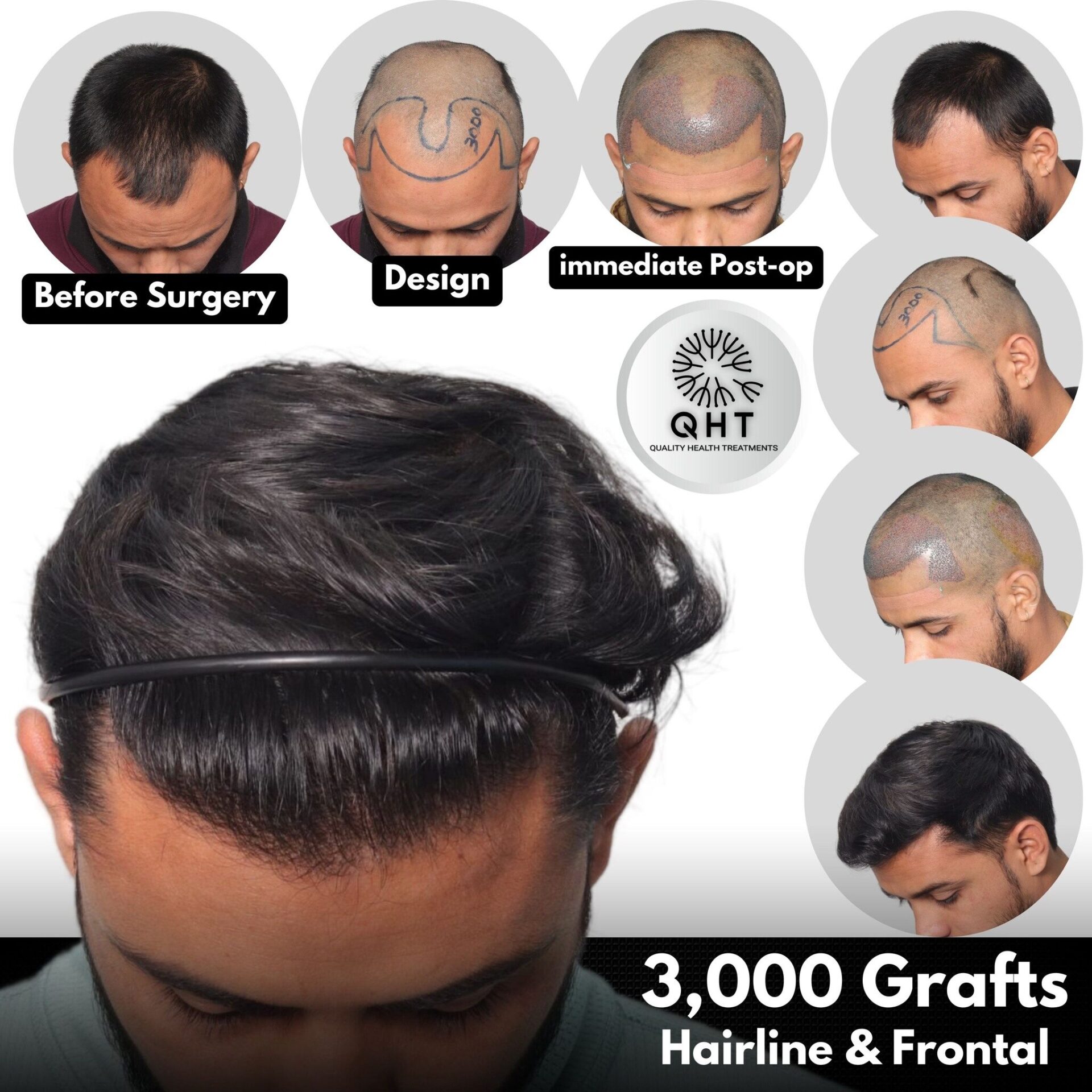 Cost of Dense Hair Transplant in India Cost of Dense Hair Transplant in India