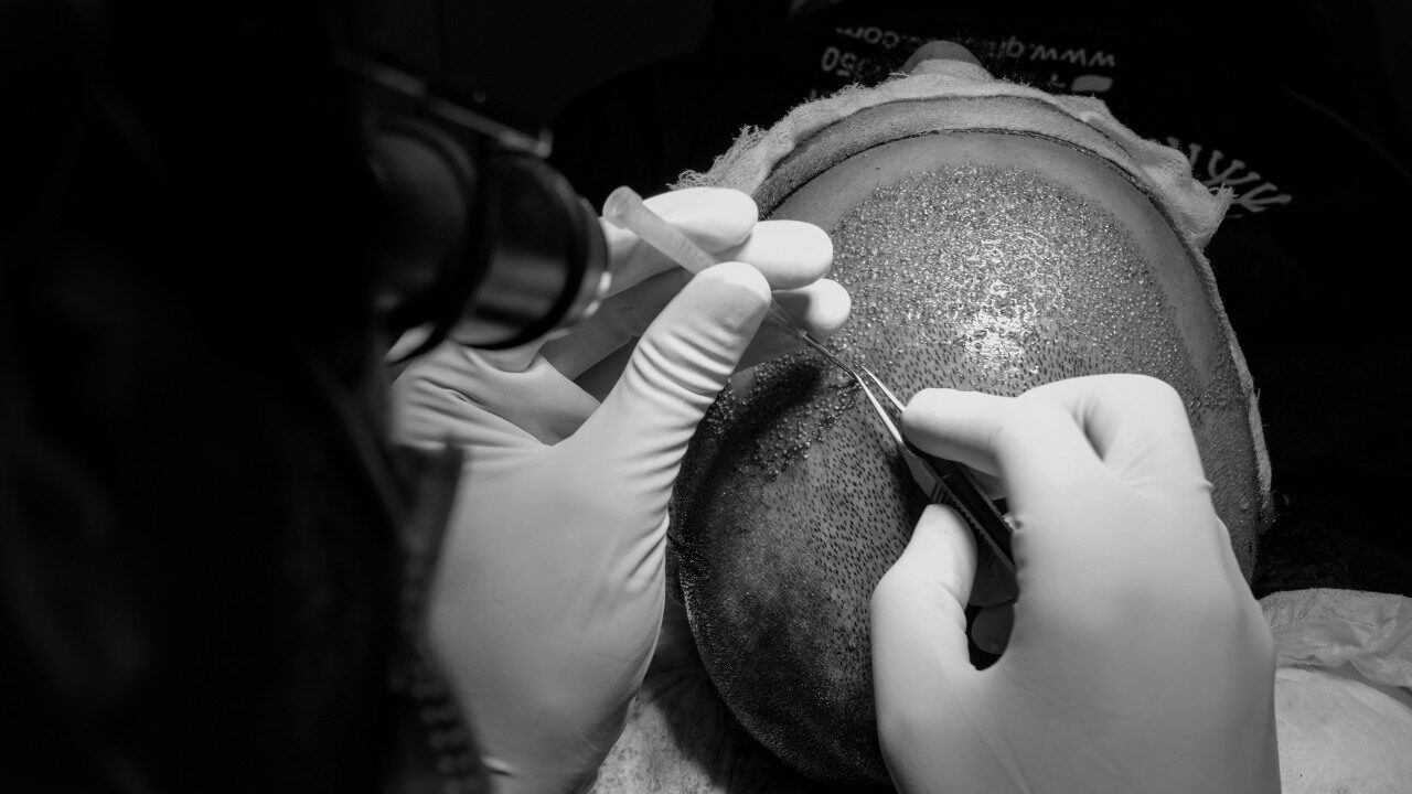 What is Dense Hair Implantation? What is Dense Hair Implantation?