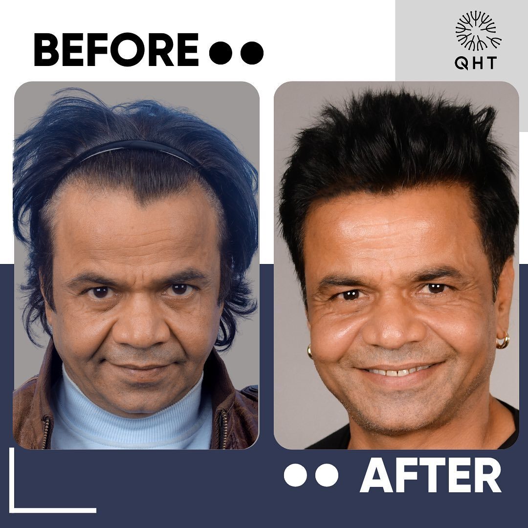 Benefits of Dense Hair Implantation Benefits of Dense Hair Implantation