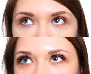 How the Eyelash Transplant Procedure Works