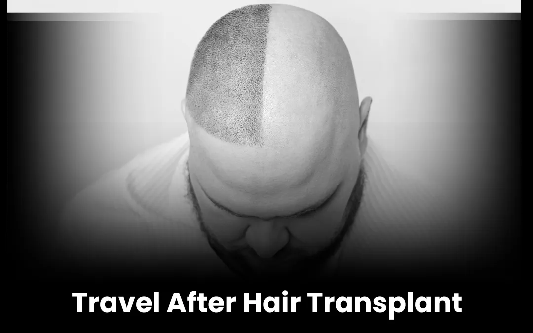 Travel after Hair Transplant – The Joy of New Beginnings