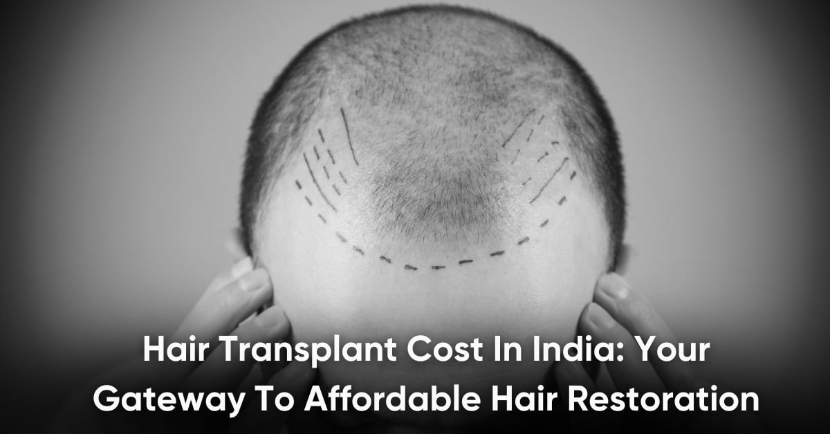Hair Transplant Cost In India: Your Gateway To Affordable Hair Restoration