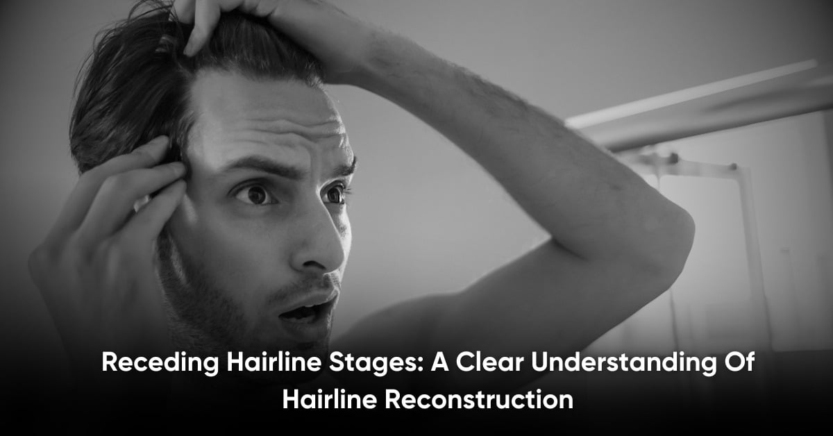Receding Hairline Stages: A Clear Understanding Of Hairline Reconstruction