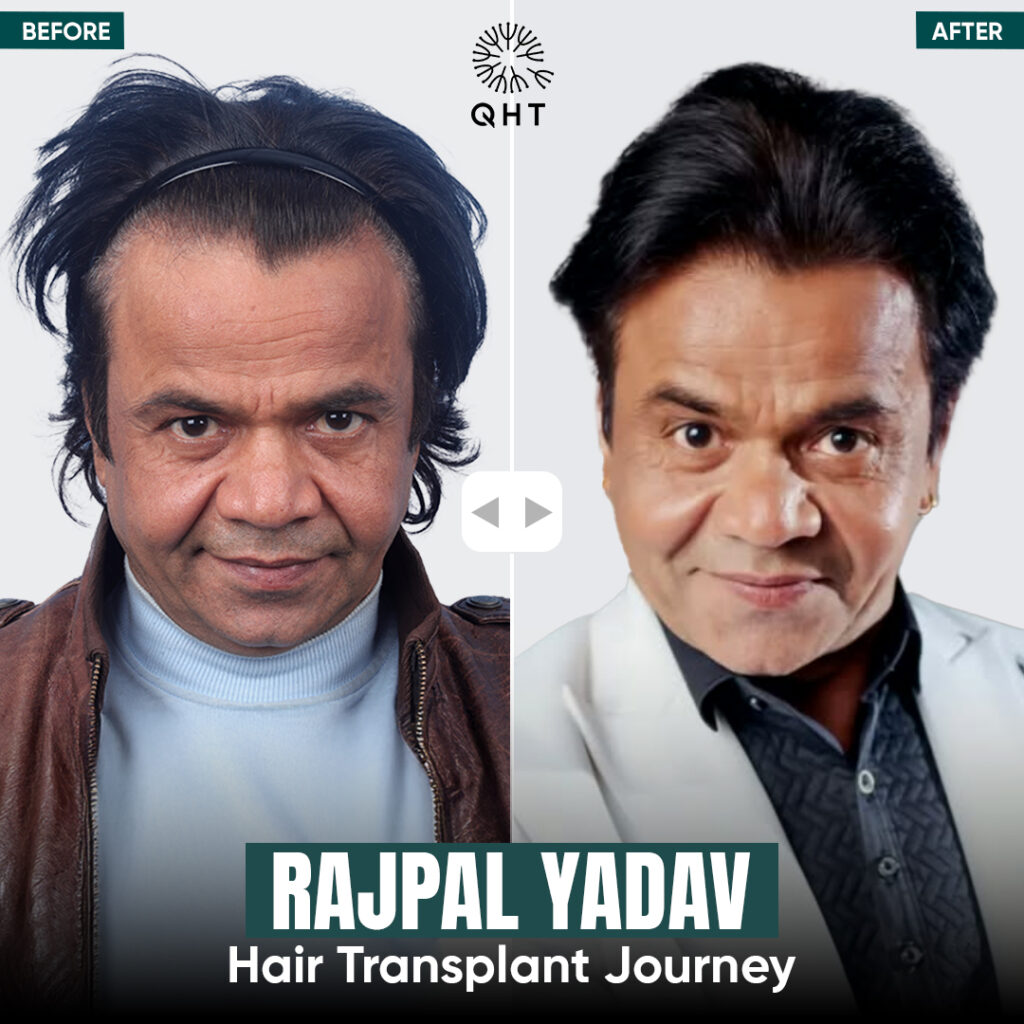 Celebrity Hair Transplant