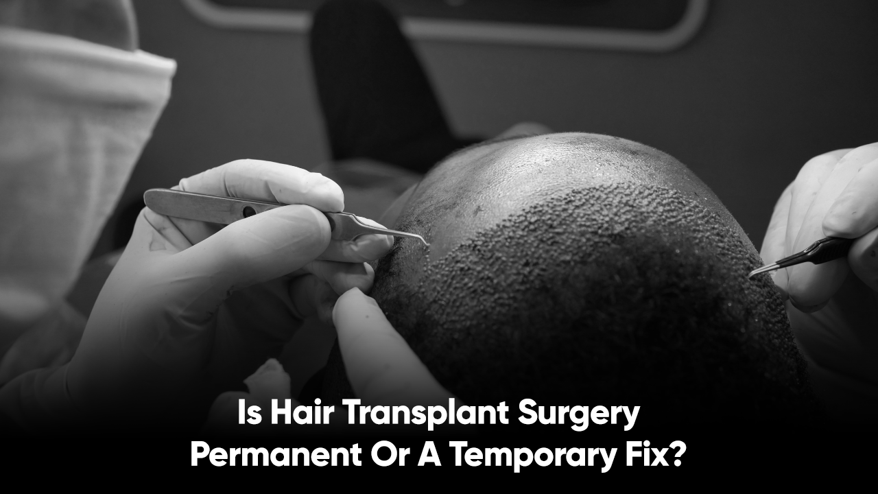 Is Hair transplant surgery permanent or a temporary fix?