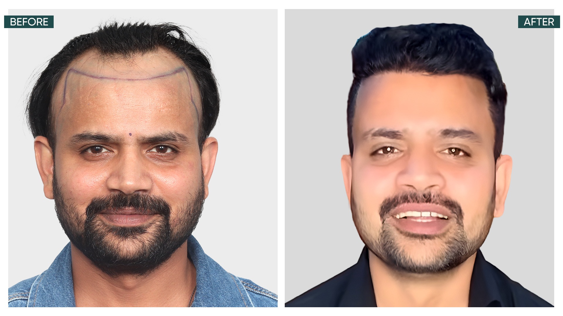 Hair Transplant Result