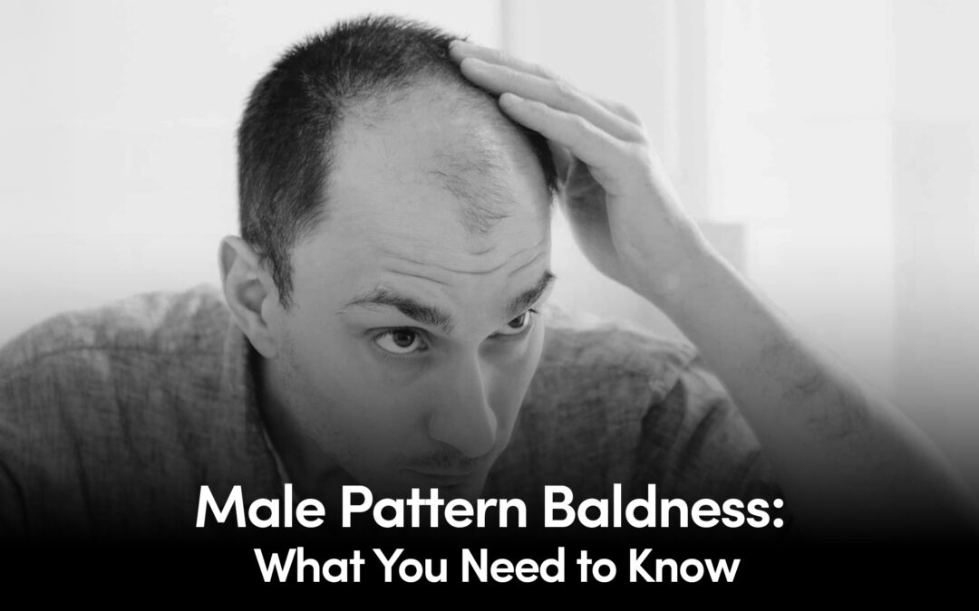 Male pattern Baldness: What you need to know