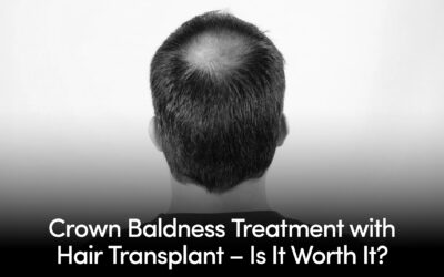 Crown Baldness Treatment with Hair Transplant – Is It Worth It?