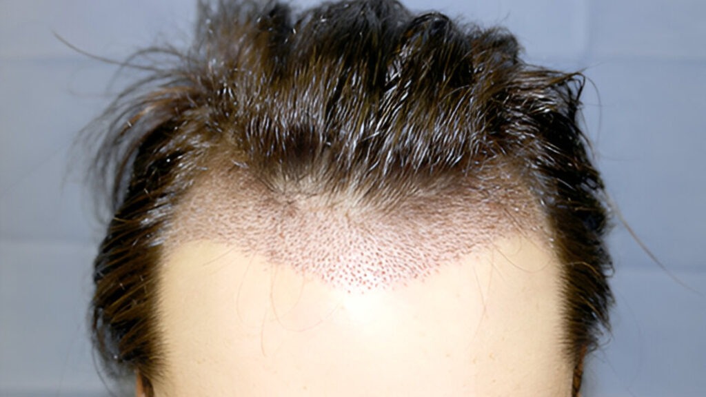 unshaved hair transplant