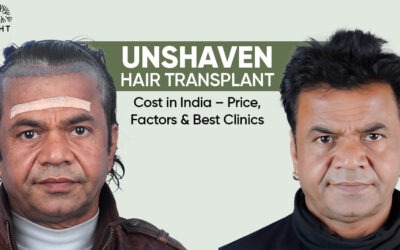 Unshaven Hair Transplant Cost in India – Price, Factors & Best Clinics