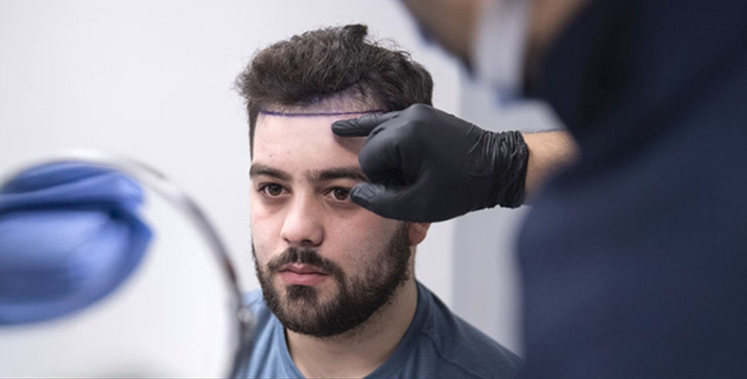 6 Hair Transplant Things To Know Before Hair Transplant