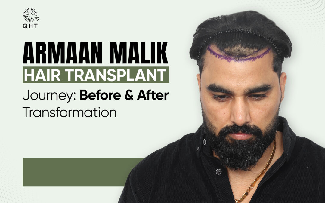 Armaan malik hair transplant journey