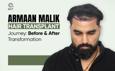 Armaan Malik Hair Transplant Journey: Before & After Transformation