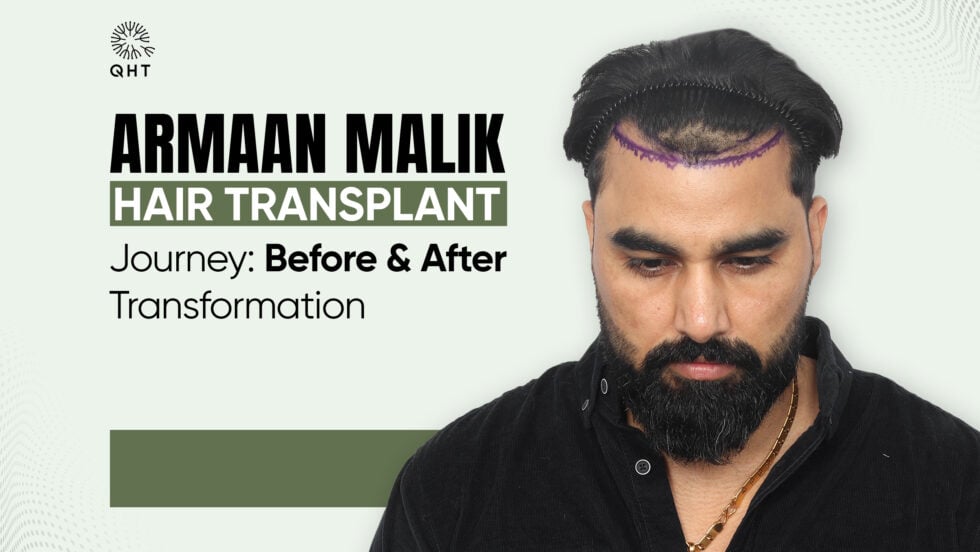Armaan Malik Hair Transplant Journey: Before & After Transformation