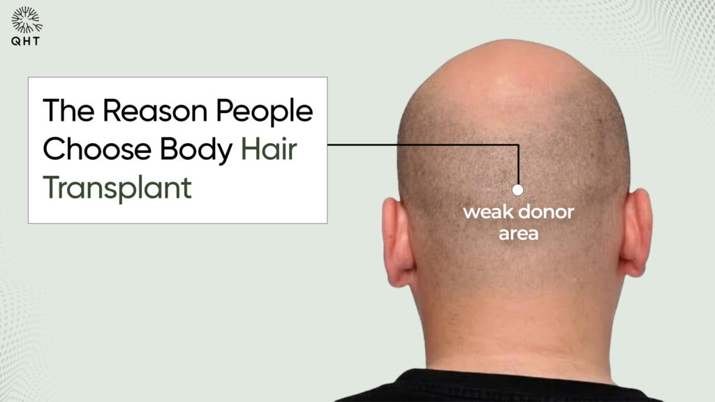 Body hair transplant reason – weak donor area in hair transplant surgery