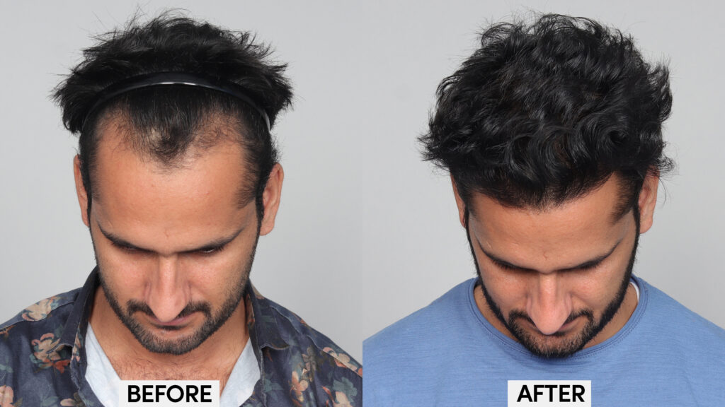 Full hair transplant