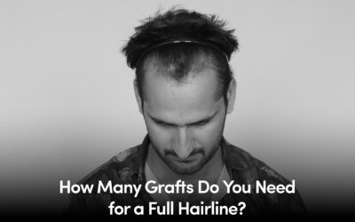 How Many Grafts Do You Need for a Full Hairline?