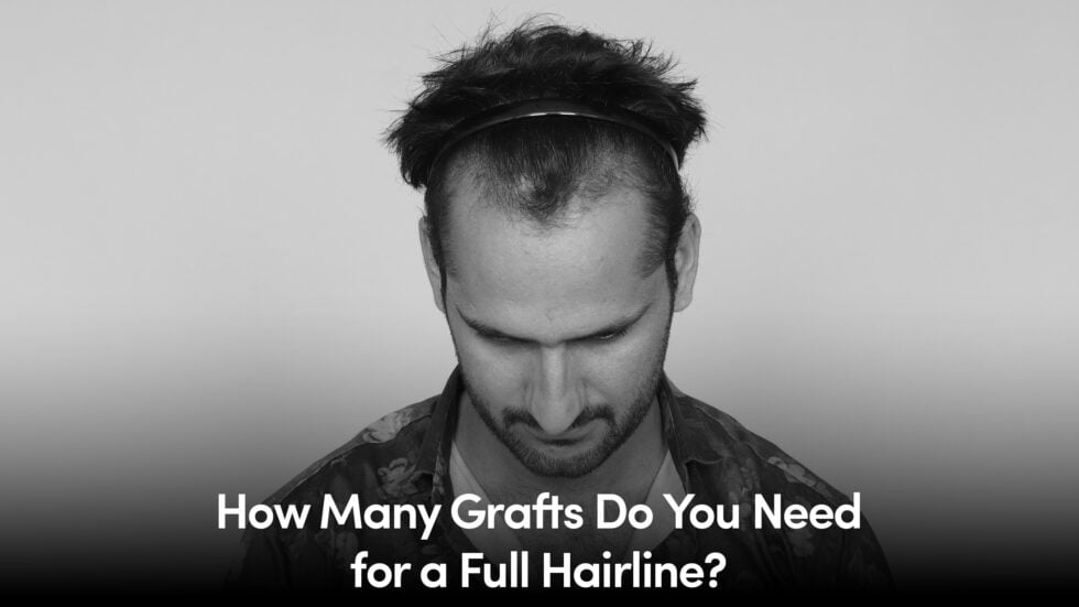 How Many Grafts Do You Need for a Full Hairline?