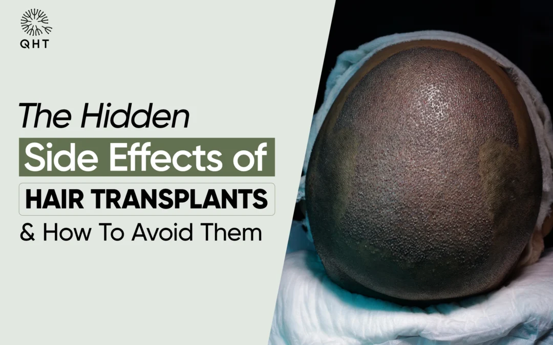 Hidden Side Effects of Hair Transplants