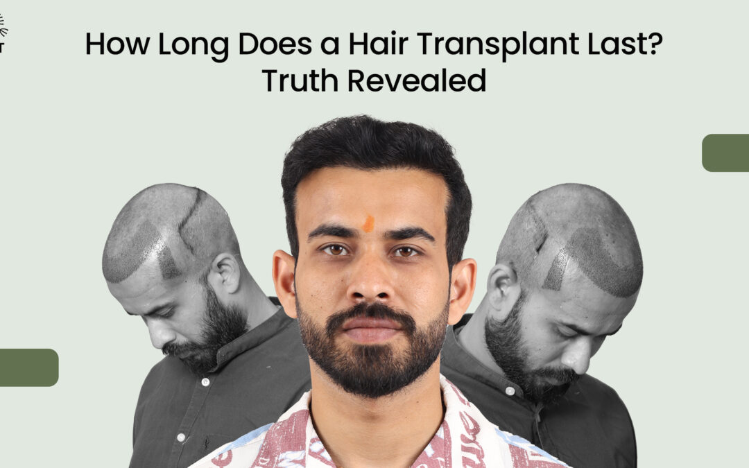 How Long Does a Hair Transplant Last?