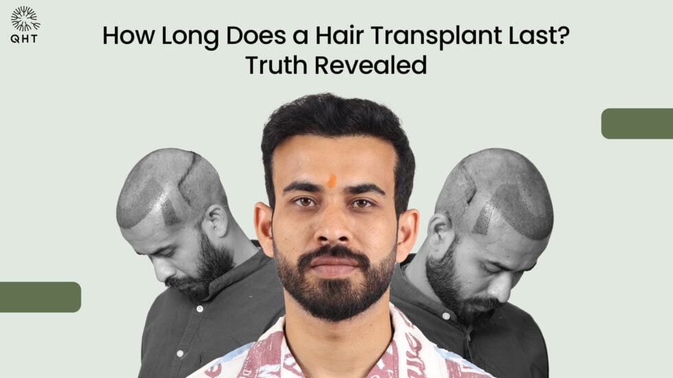 How Long Does a Hair Transplant Last? Truth Revealed