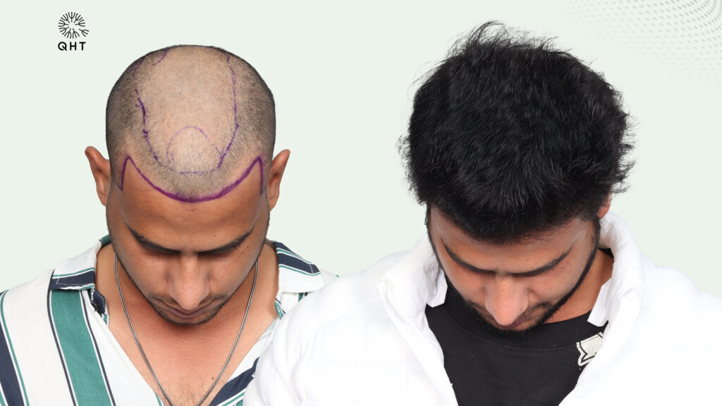 Mehtab Saifi hair transplant before and after transformation, showcasing receding hairline and hair growth result.