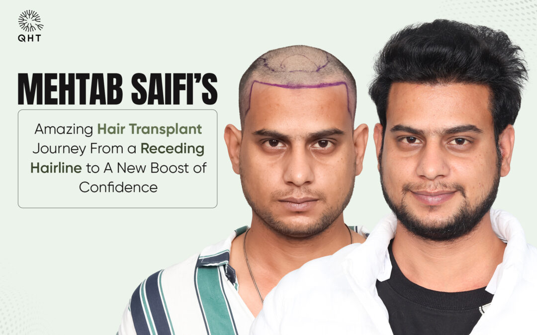 Mehtab Saifi's amazing hair transplant journey from a receding hairline to a new boost of confidence.