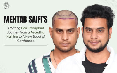 Mehtab Saifi’s Amazing Hair Transplant Journey- From a Receding Hairline to A New Boost of Confidence