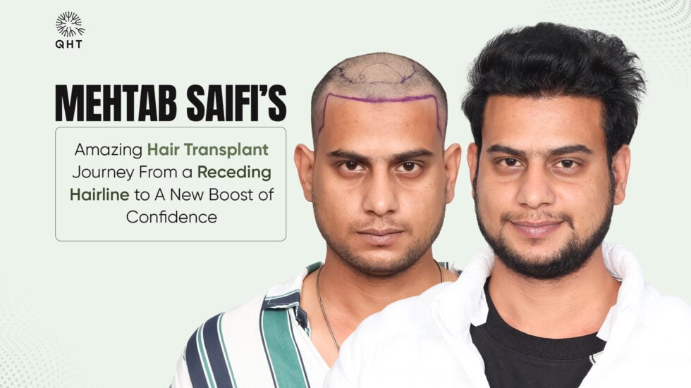 Mehtab Saifi’s Amazing Hair Transplant Journey- From a Receding Hairline to A New Boost of Confidence