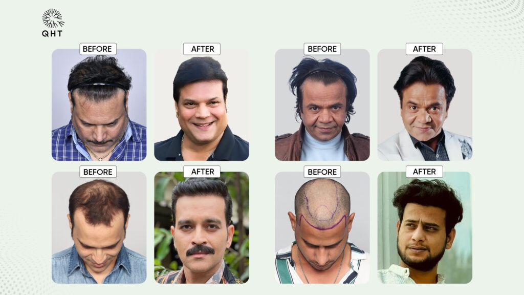 Before and after hair transplant results of celebrities showcasing transformation with QHT technique.