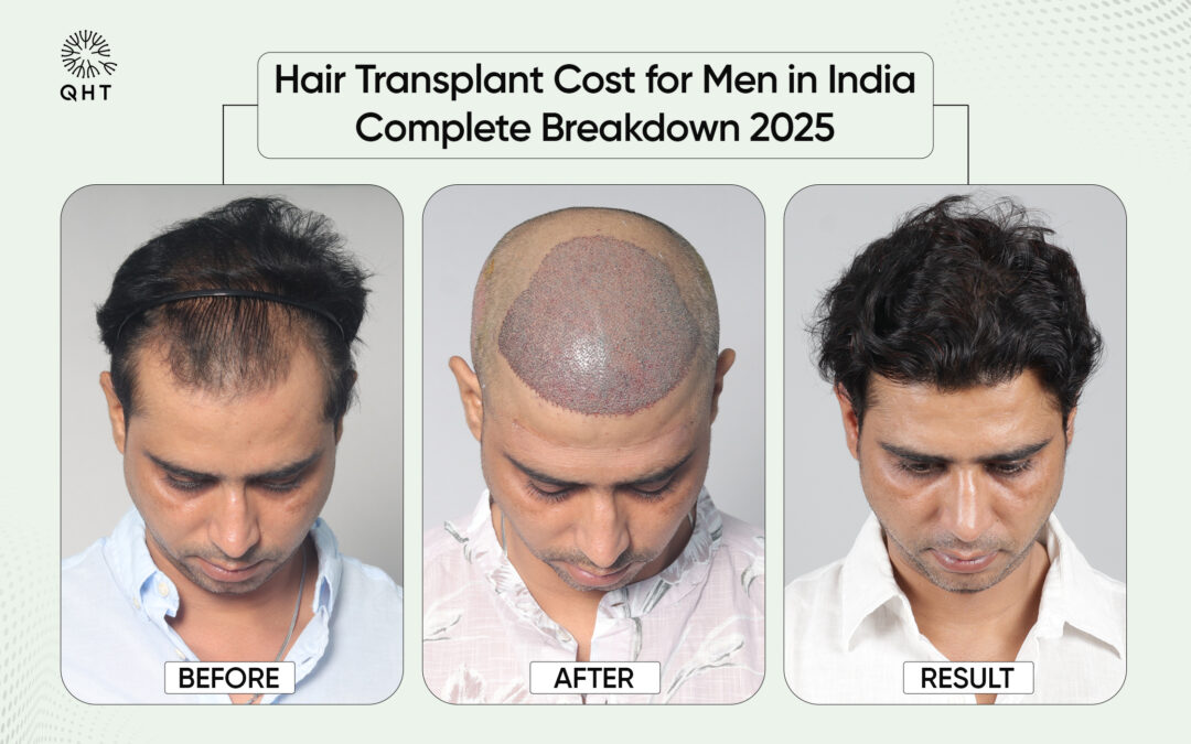 Hair Transplant Cost for Men in India: Complete Breakdown 2025