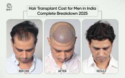 Hair Transplant Cost for Men in India: Complete Breakdown 2025