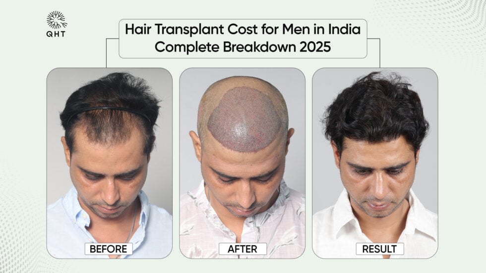 Hair Transplant Cost for Men in India: Complete Breakdown 2025