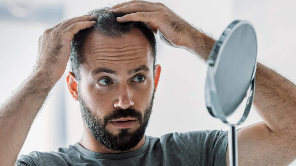 receding hairline