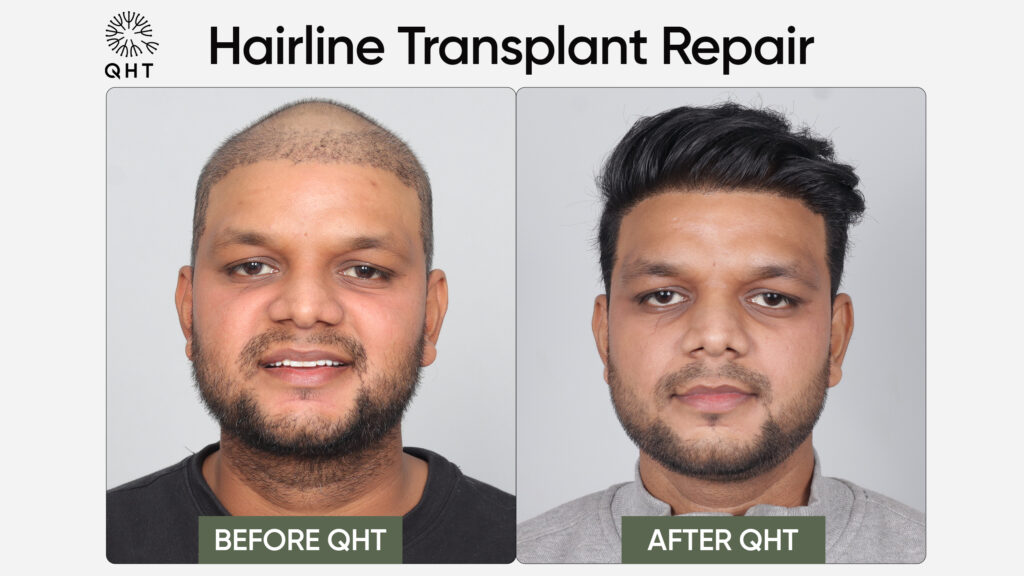Before and after hairline correction treatment at QHT Clinic.