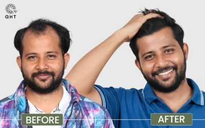 Checklist for choosing the Best Hair Transplant Clinic in Delhi