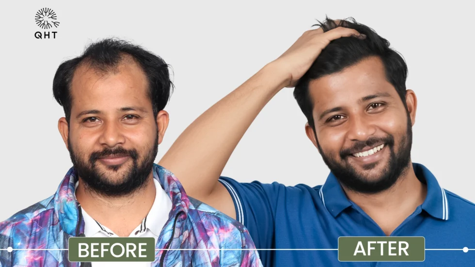 Checklist for choosing the Best Hair Transplant Clinic in Delhi